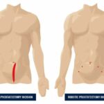 Chirurgia Prostatei cu metoda daVinci - Victor Puiu - August 2017